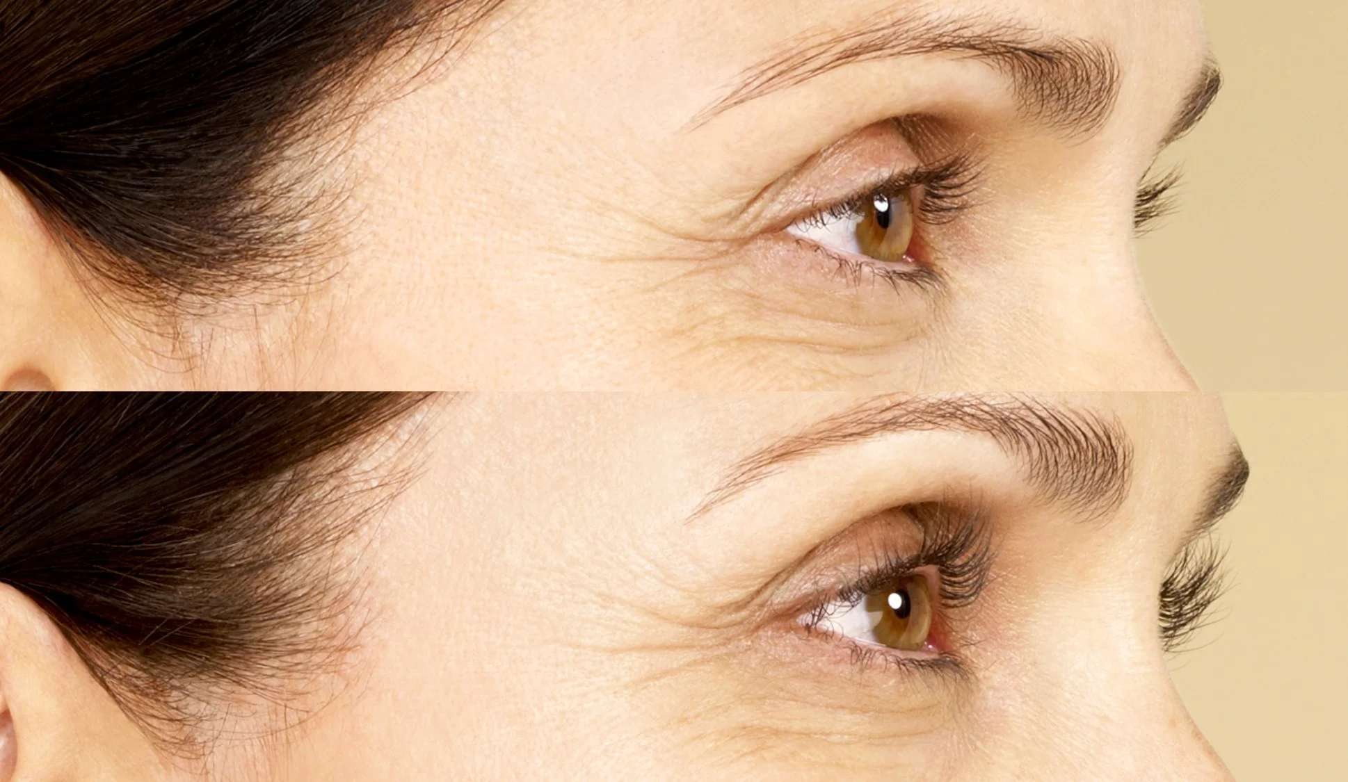 Before and after Latisse, image credit Allergan