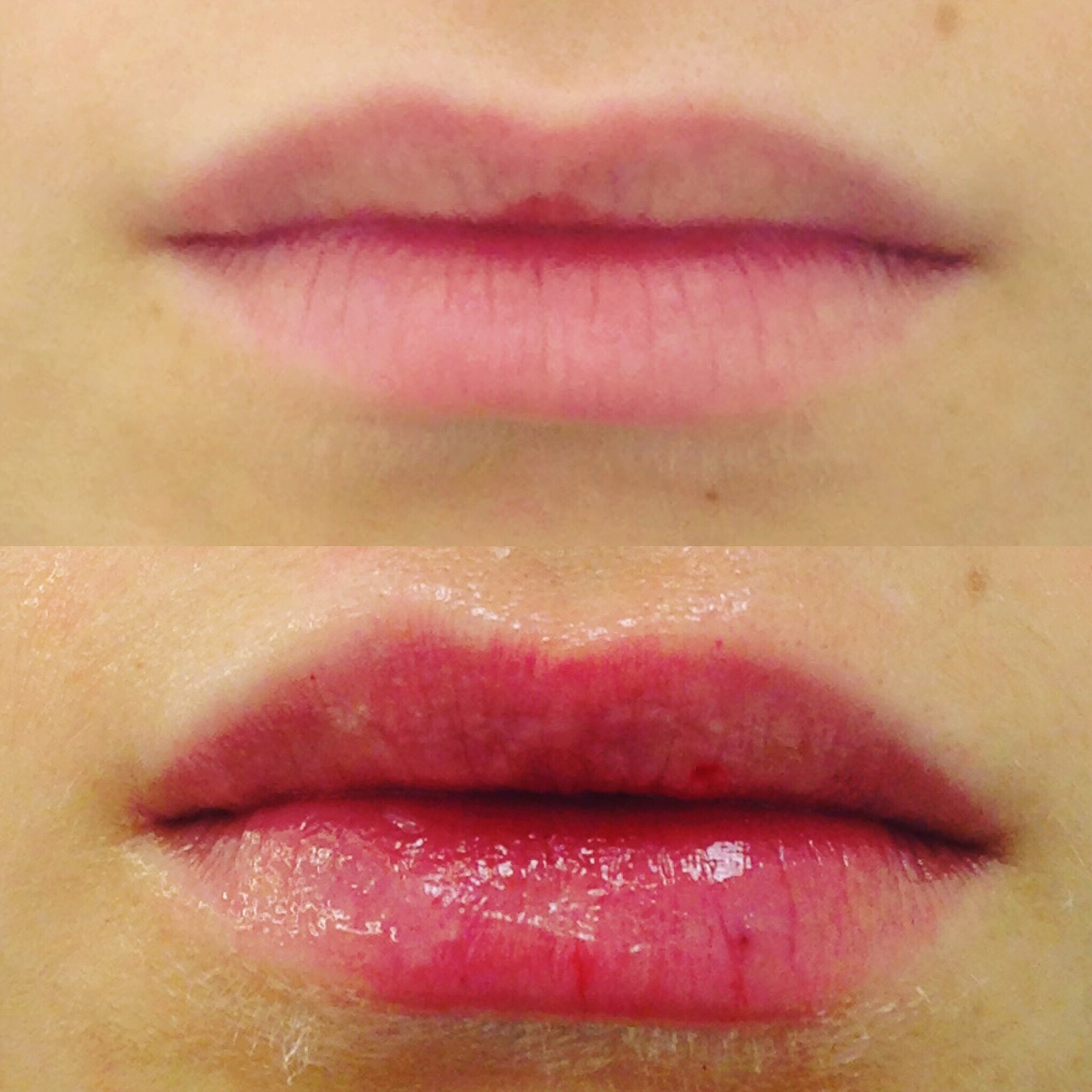 Actual patient of Dr. Devgan, before and after lip augmentation with Juvederm, New York City