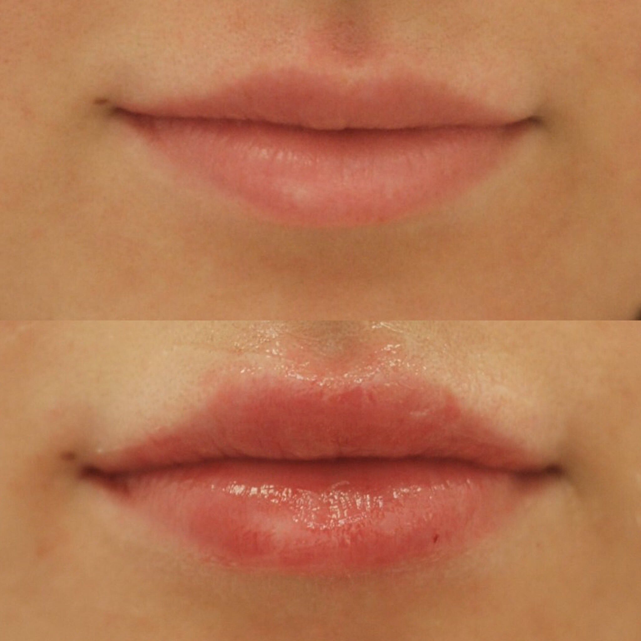 Actual patient of Dr. Devgan, before and after lip augmentation with Juvederm, New York City
