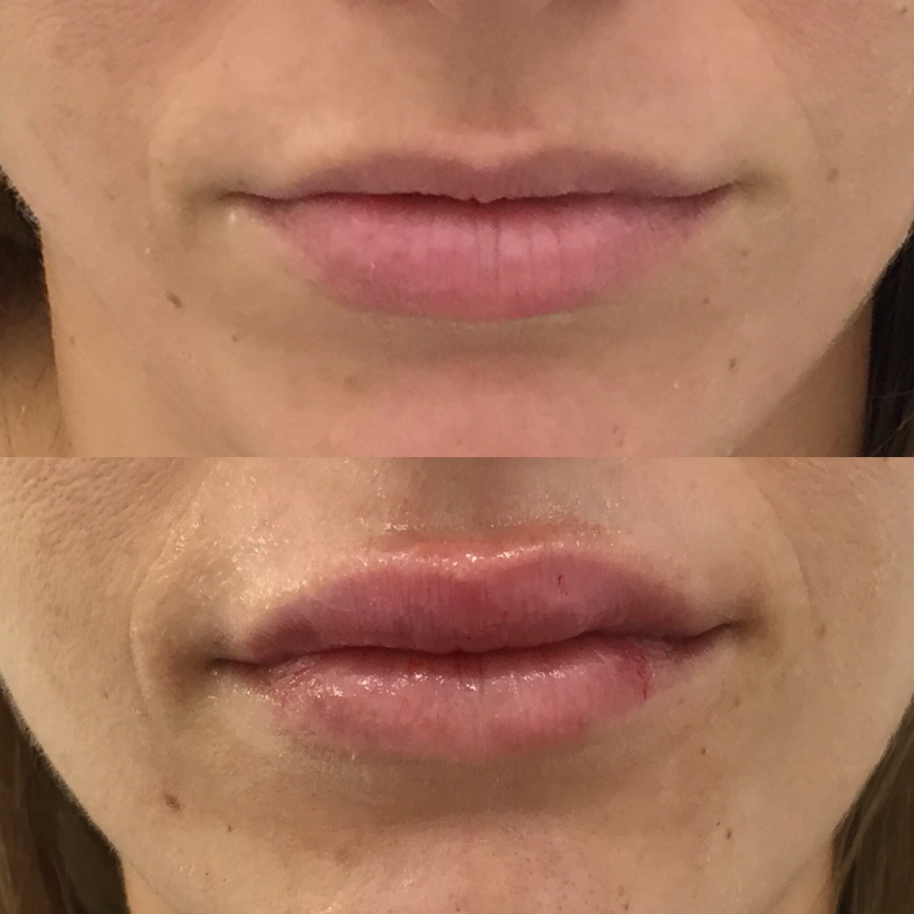 Actual patient of Dr. Devgan, before and after lip augmentation with Juvederm, New York City