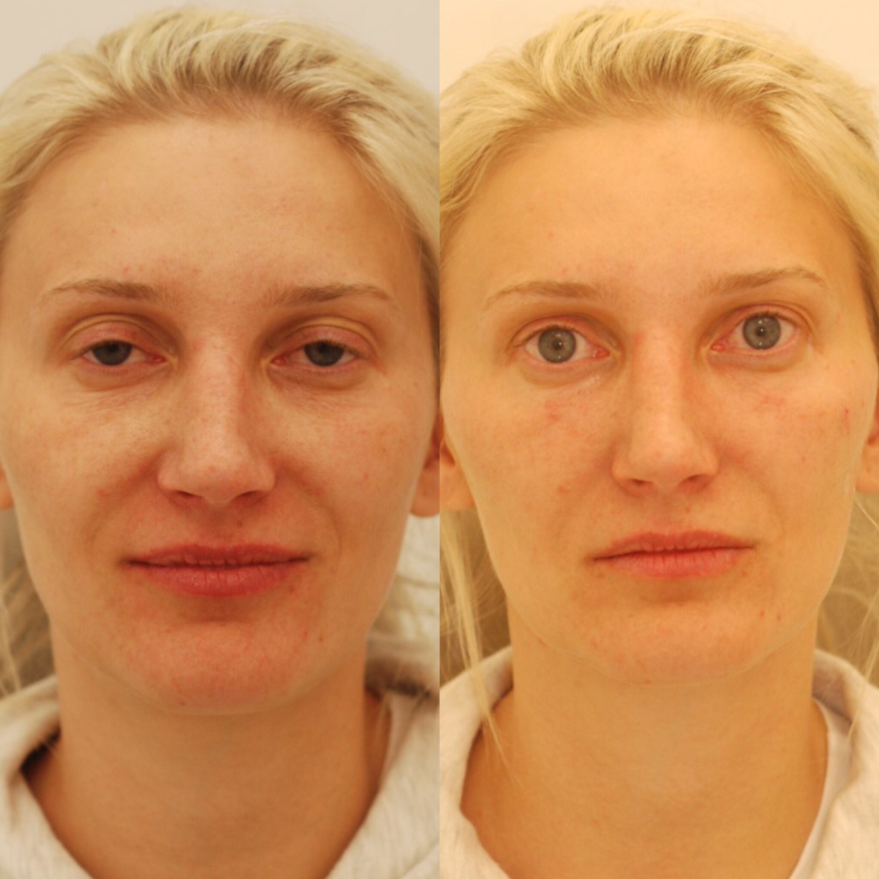 Actual patient of Dr. Devgan, before and after under-eye augmentation