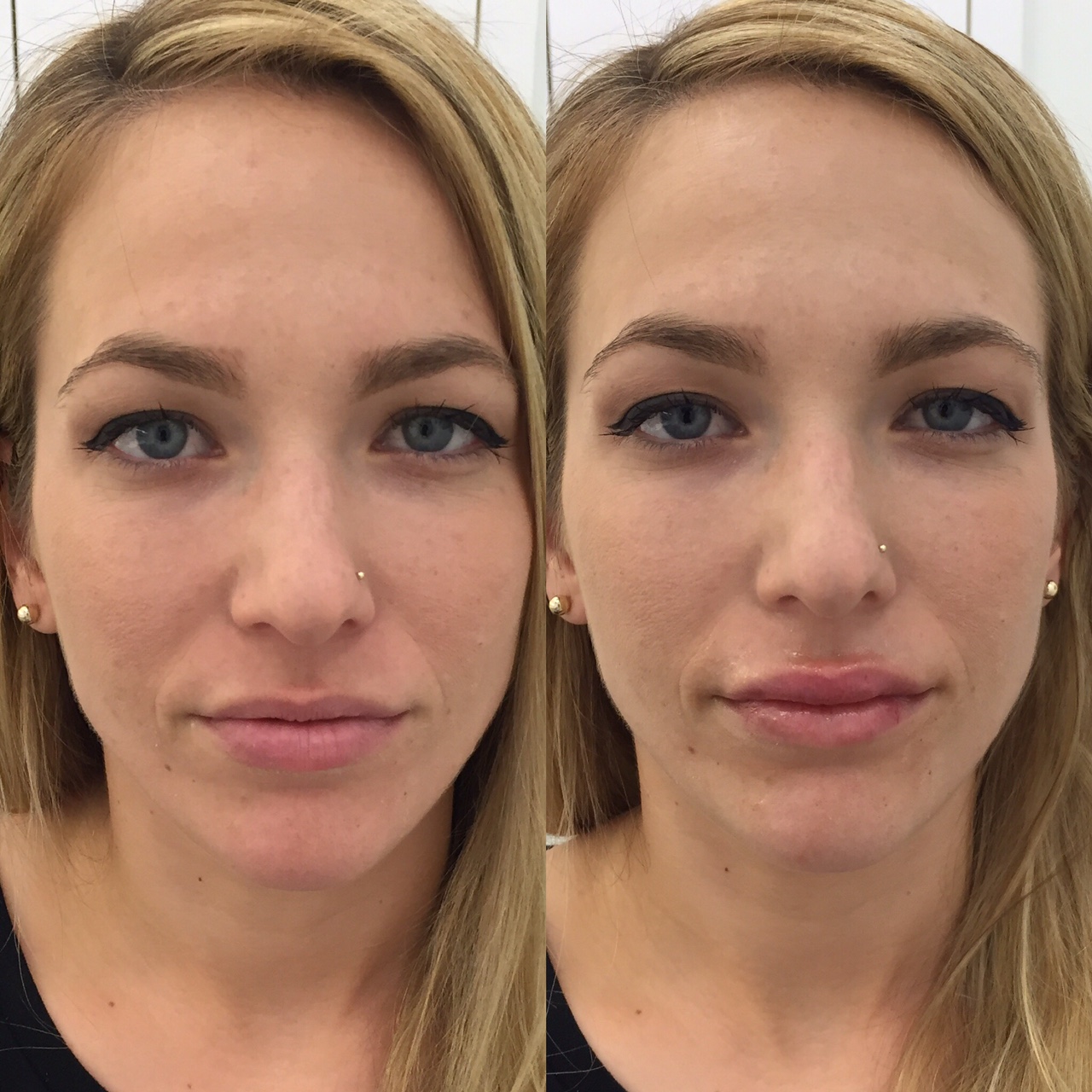 Actual patient of Dr. Devgan, before and after lip augmentation