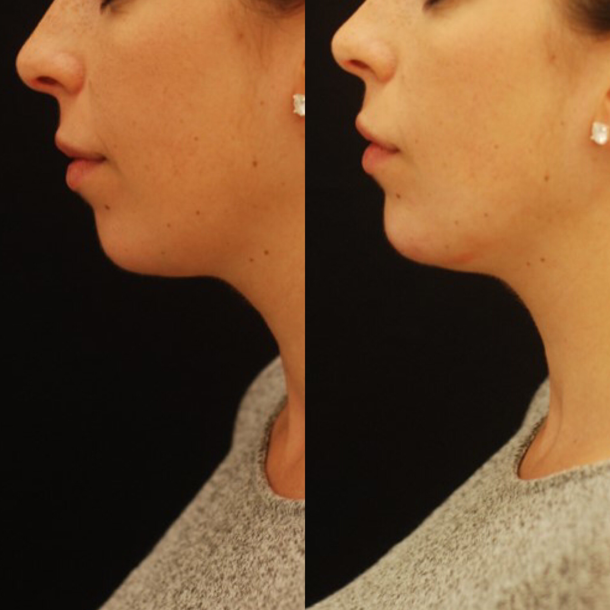 Chin augmentation with injectable filler. Actual patient of Dr. Devgan