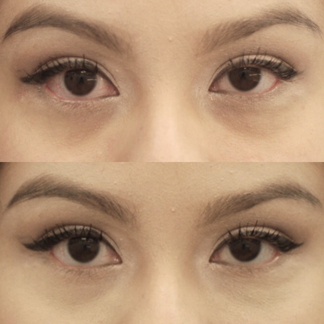 Actual patient of Dr. Devgan, before and immediately after tear trough filler