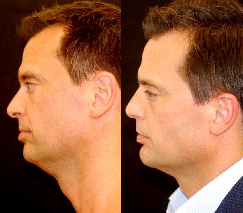 Chin augmentation with chin implant. Adjunctive procedures: submental liposuction, rhinoplasty. Actual patient of Dr. Devgan