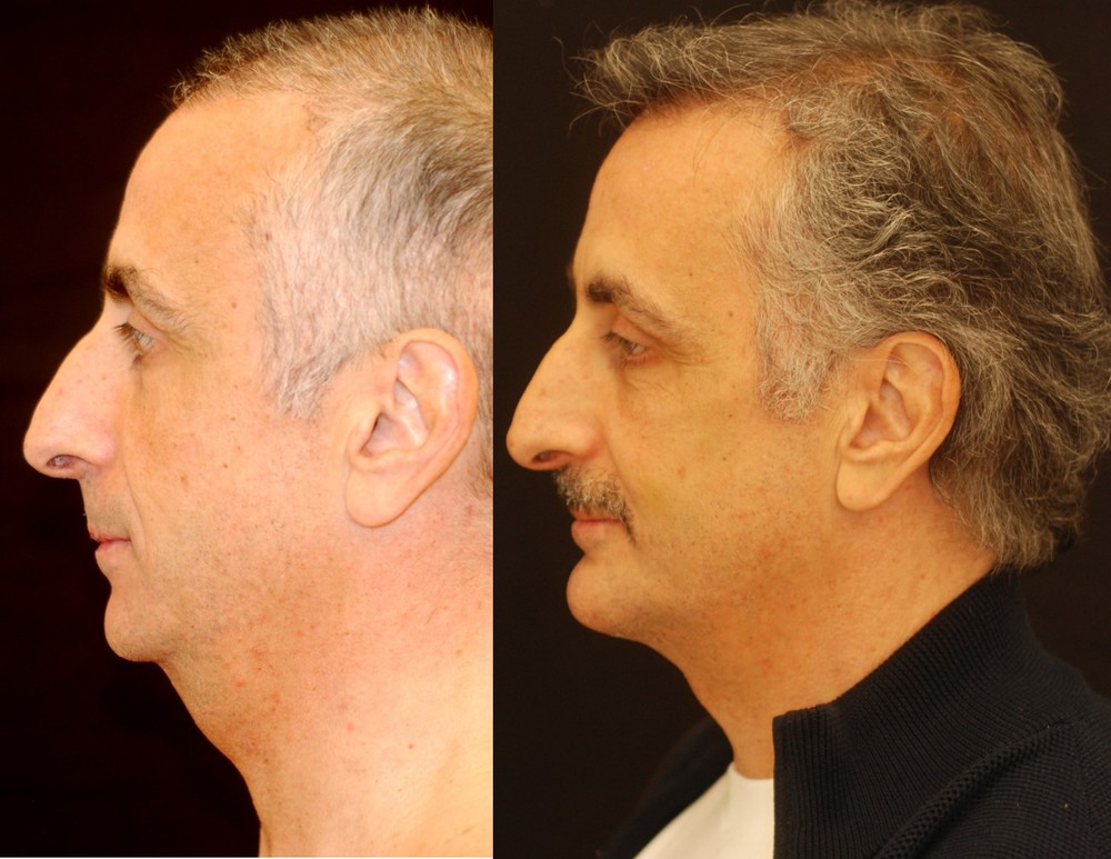 Chin augmentation with chin implant. Adjunctive procedures: necklift, submental liposuction. Actual patient of Dr. Devgan