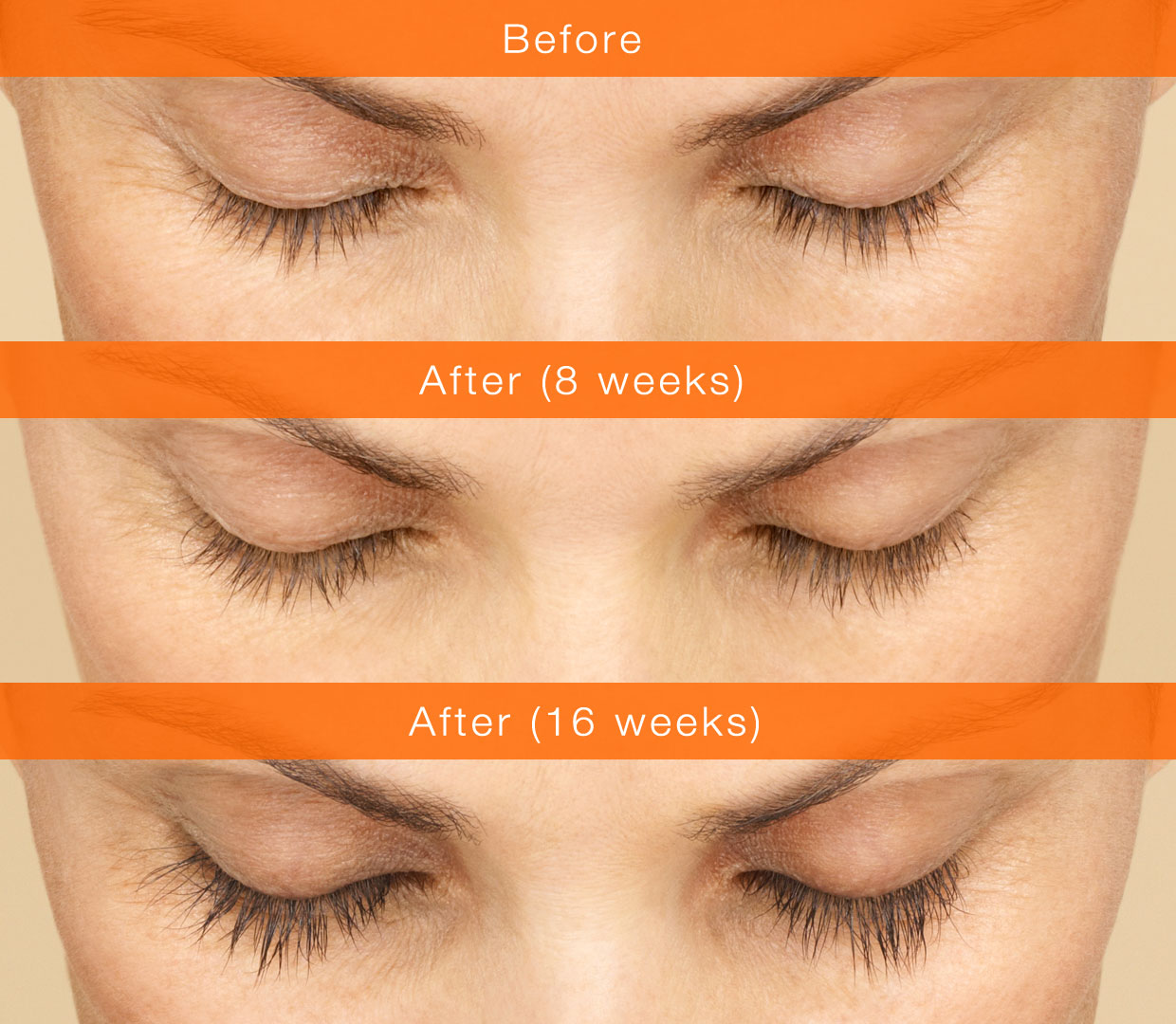 Latisse, before (above), 8 weeks after (middle), and 16 weeks after (below) daily use. Image credit Allergan.