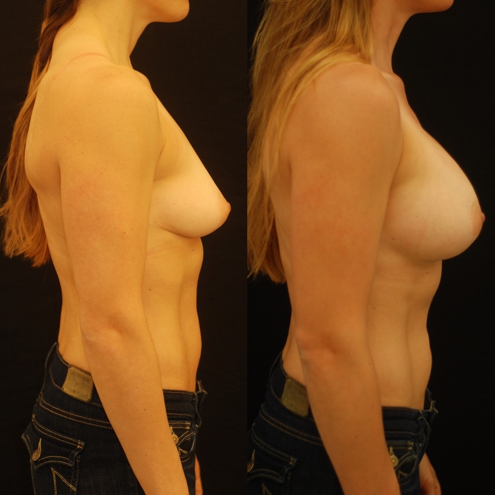 Actual patient of Dr. Devgan, before and 2 months after breast augmentation with internal lift.
