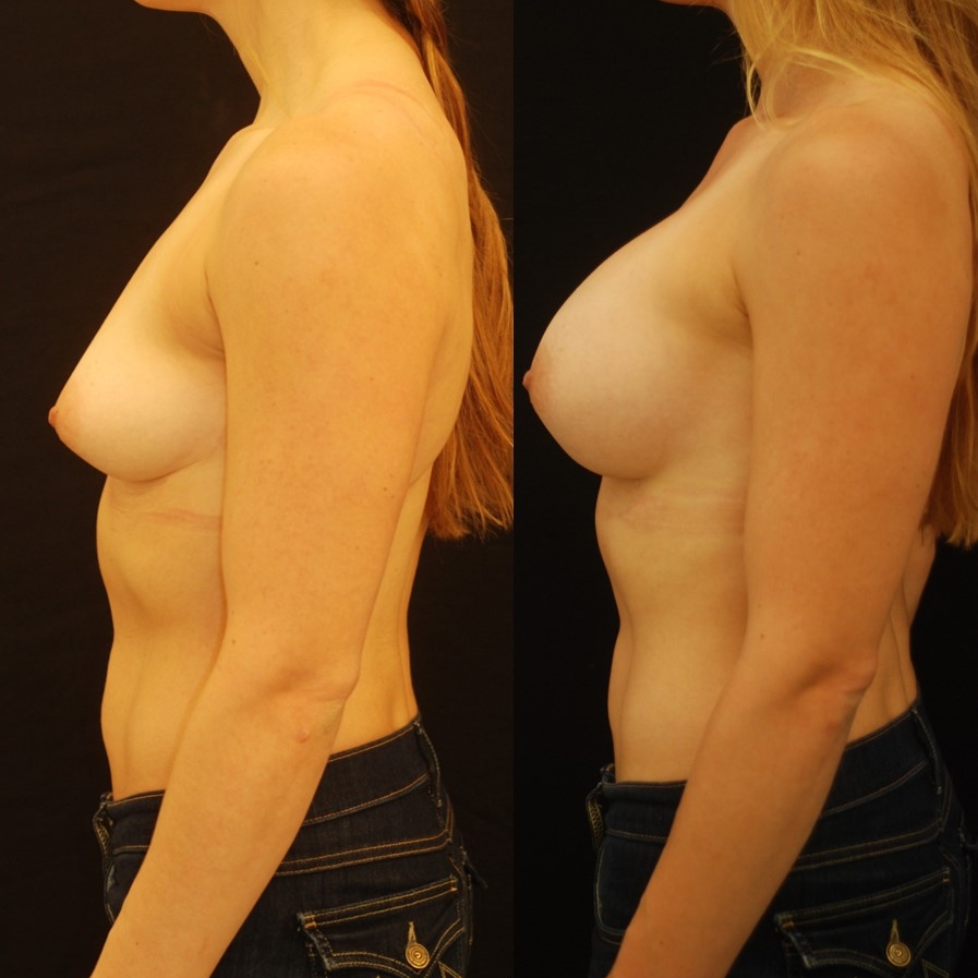 Breast augmentation with internal lift (no scars on the breast) .