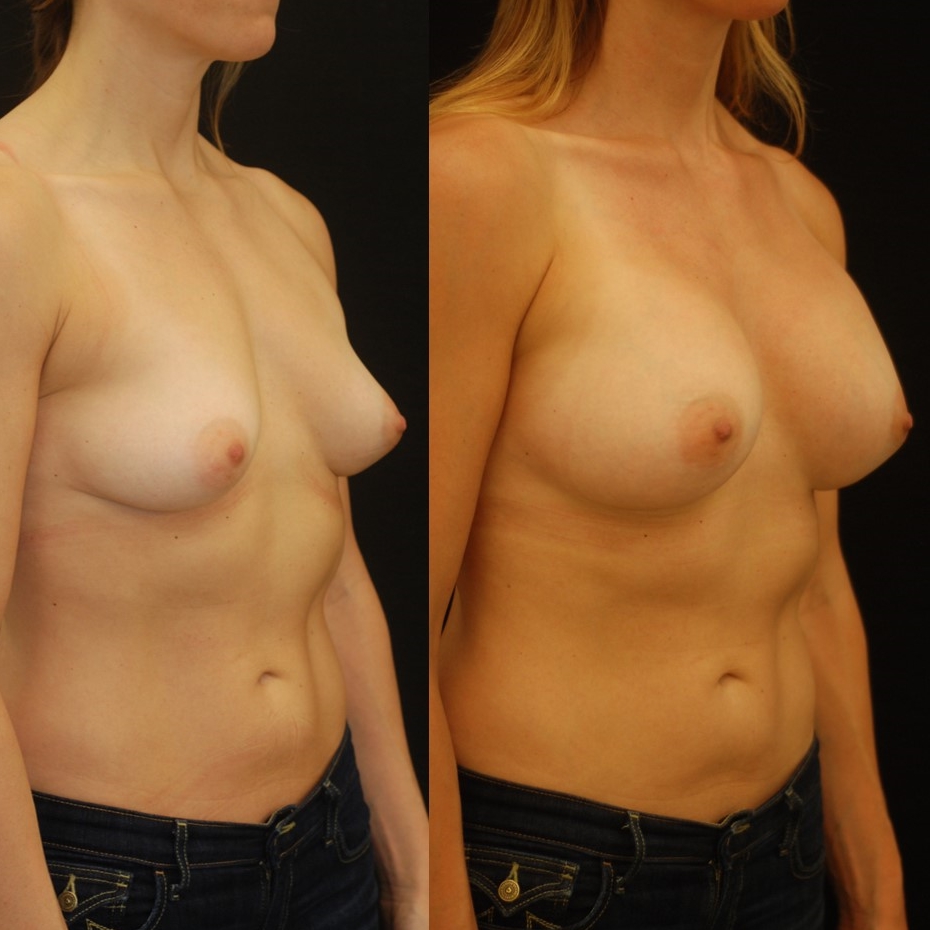 Actual patient of Dr. Devgan, before and 2 months after breast augmentation with internal lift.