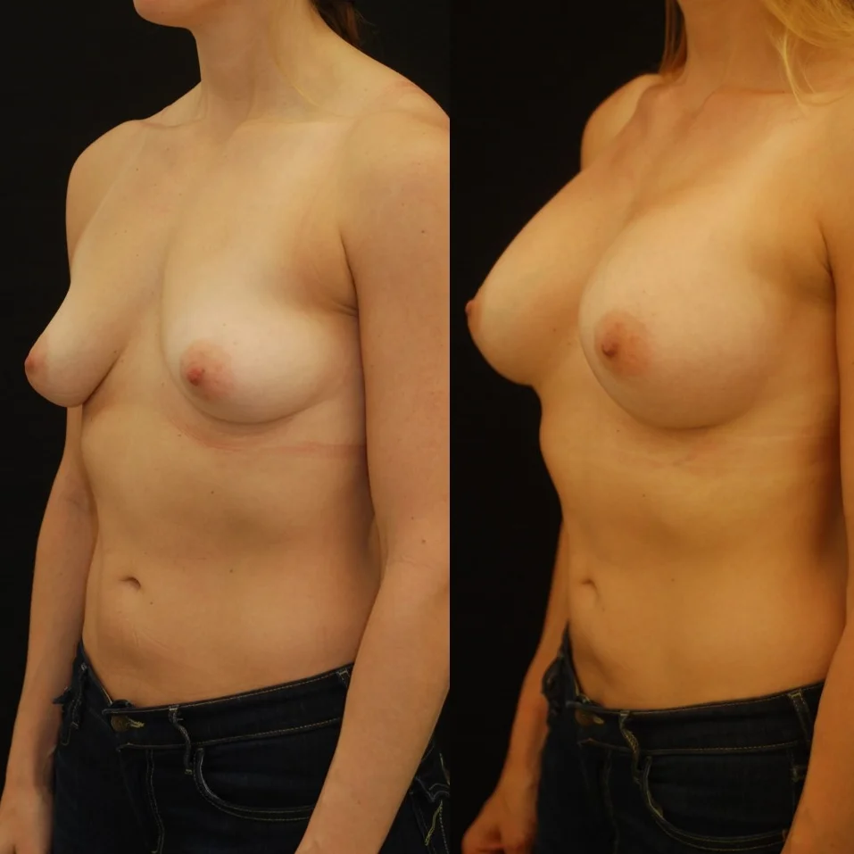Actual patient of Dr. Devgan, before and 2 months after breast augmentation with internal lift.