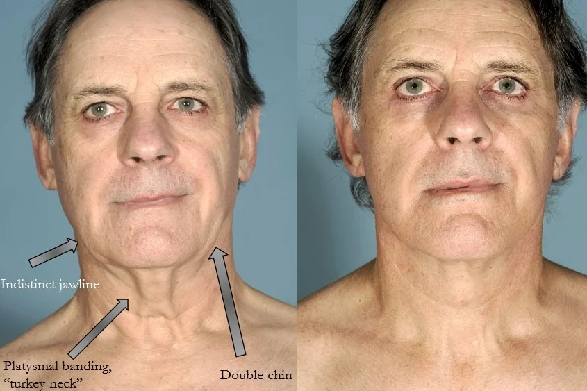 Actual patient of Dr. Devgan, before and after necklift