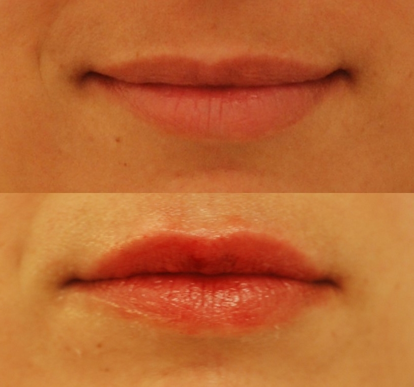 This actual patient of Dr. Devgan had previously experimented with lip filler that left her lips looking too large and unnatural. Dr. Devgan added volume to her upper lip to give her a more voluptuous, full appearance, while maintaining a natural look (bottom photo).