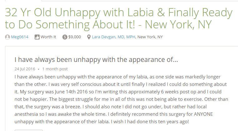 Verified patient review from a labiaplasty patient, via RealSelf.com