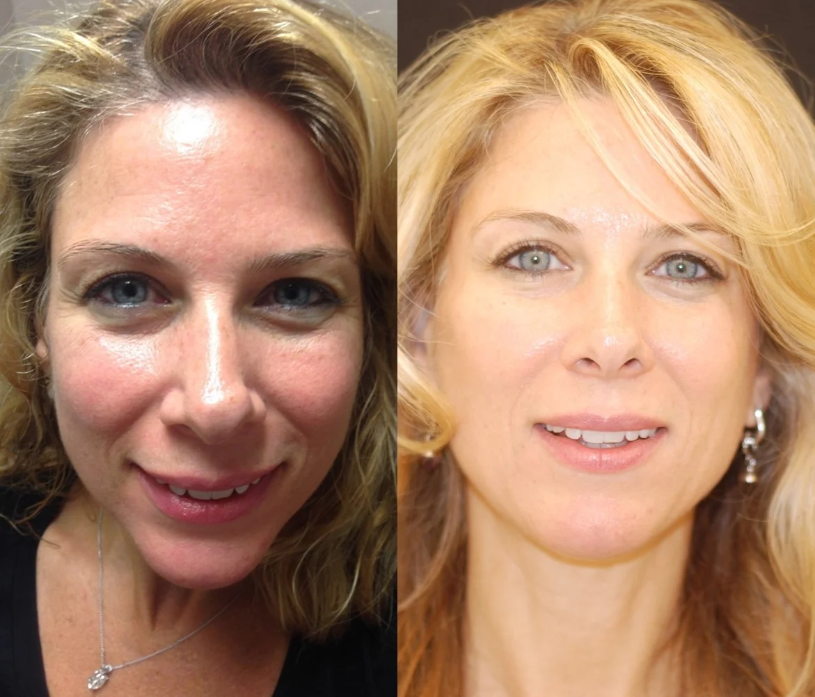 Actual patient of Dr. Devgan, before and after Botox to forehead/ crows feet/ glabella/ DAOs, Juvederm to lips, Juvederm to nasolabial folds, Voluma to cheekbones.