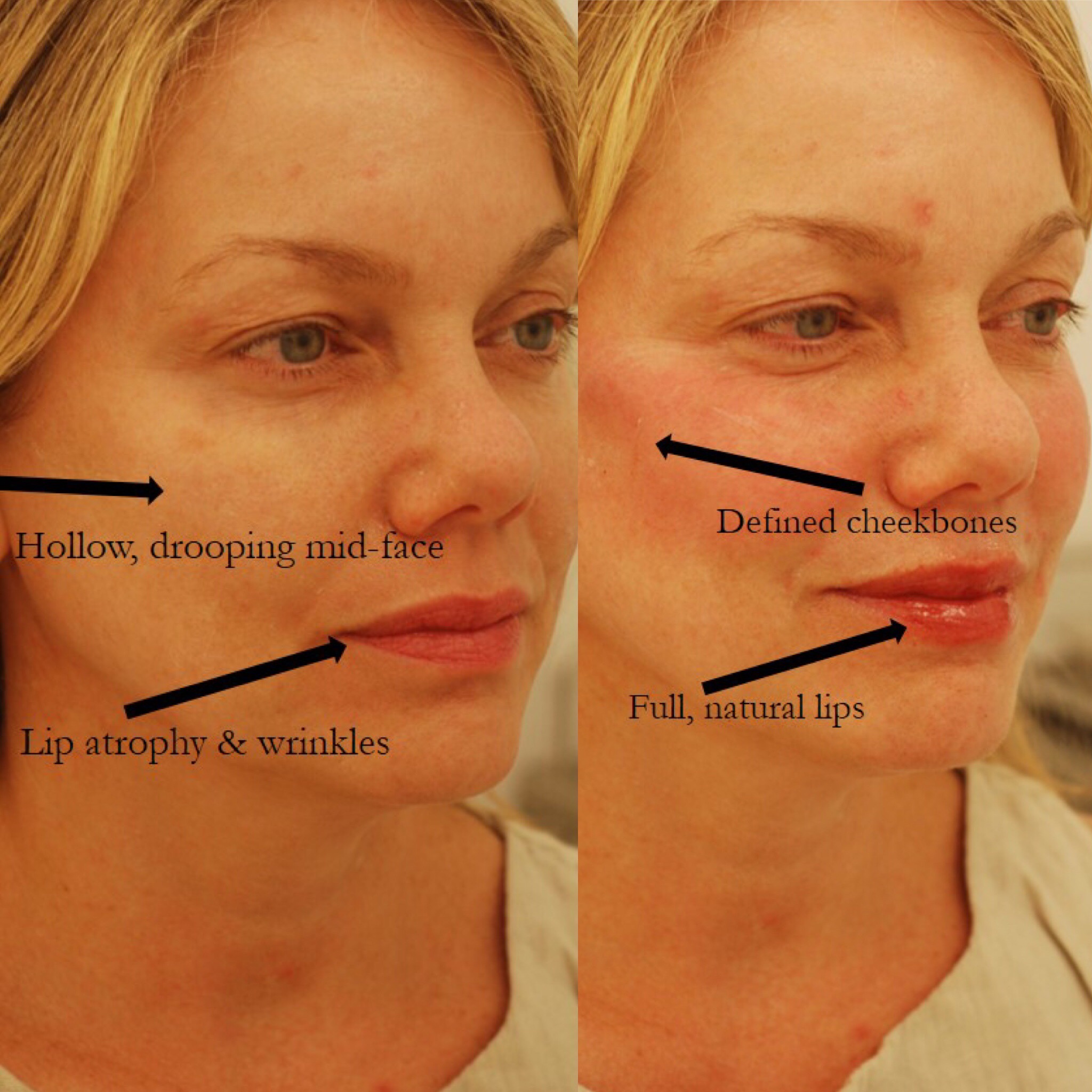 Actual patient of Dr. Devgan, before and after Botox to forehead/ crows feet/ glabella/ DAOs, Juvederm to lips, Voluma to cheekbones.