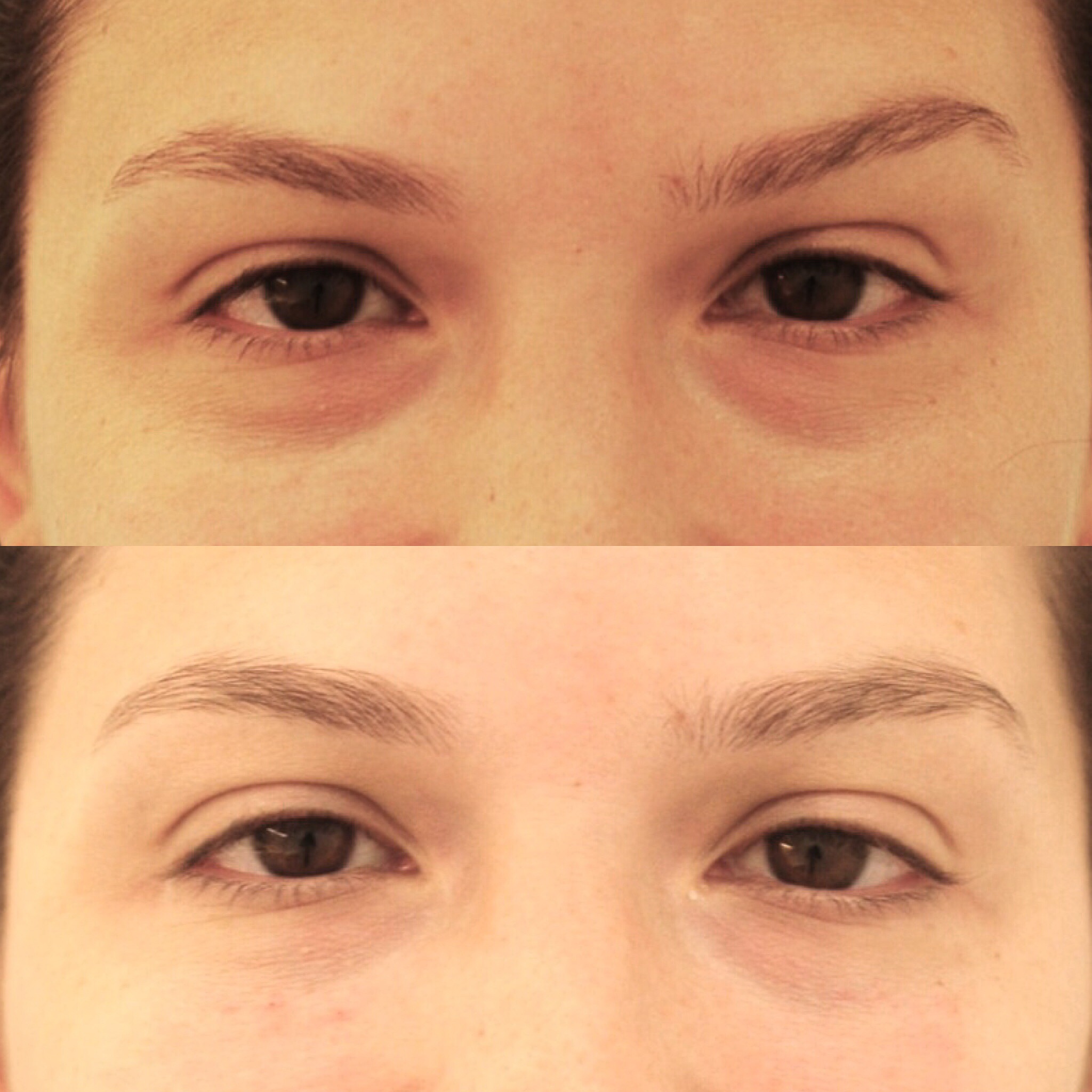 Actual patient of Dr. Devgan, before and after tear trough injection