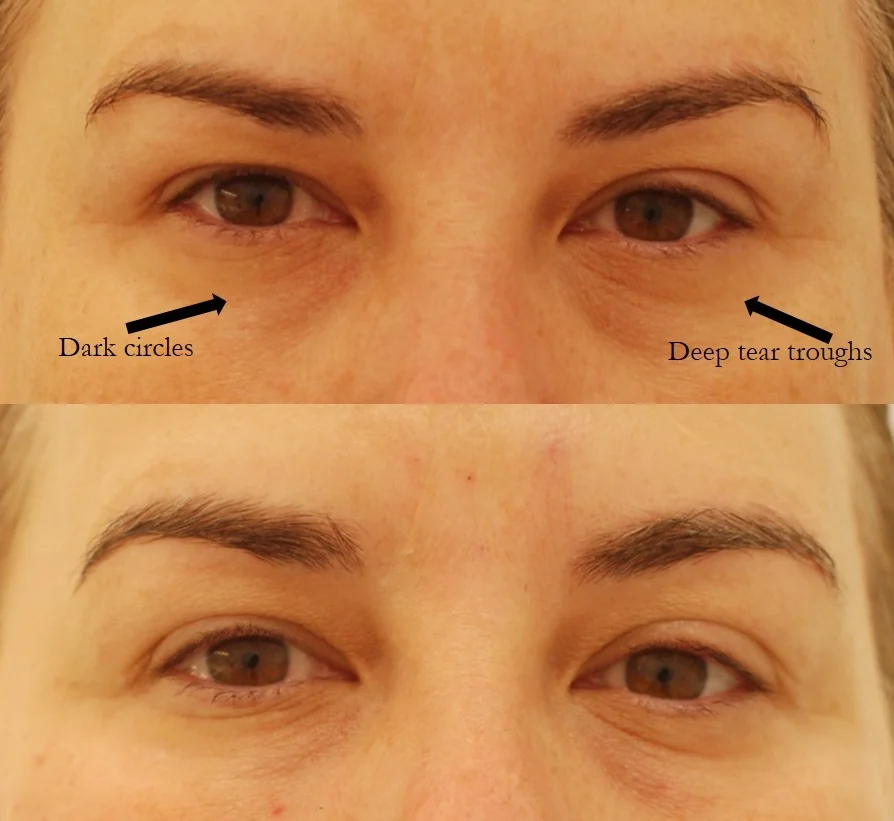 Actual patient of Dr. Devgan, before and after tear trough injection