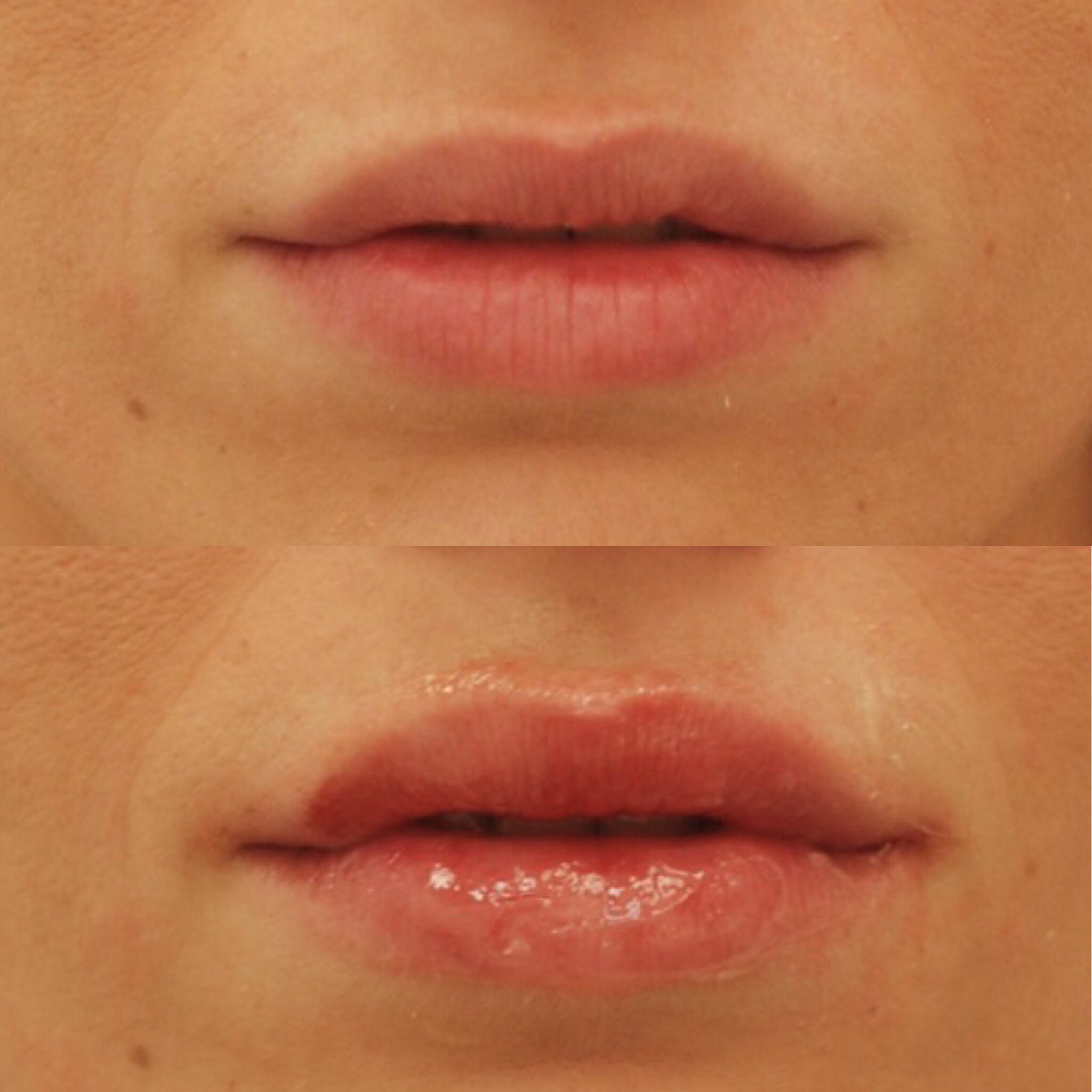 Actual patient of Dr. Devgan, before and after lip augmentation