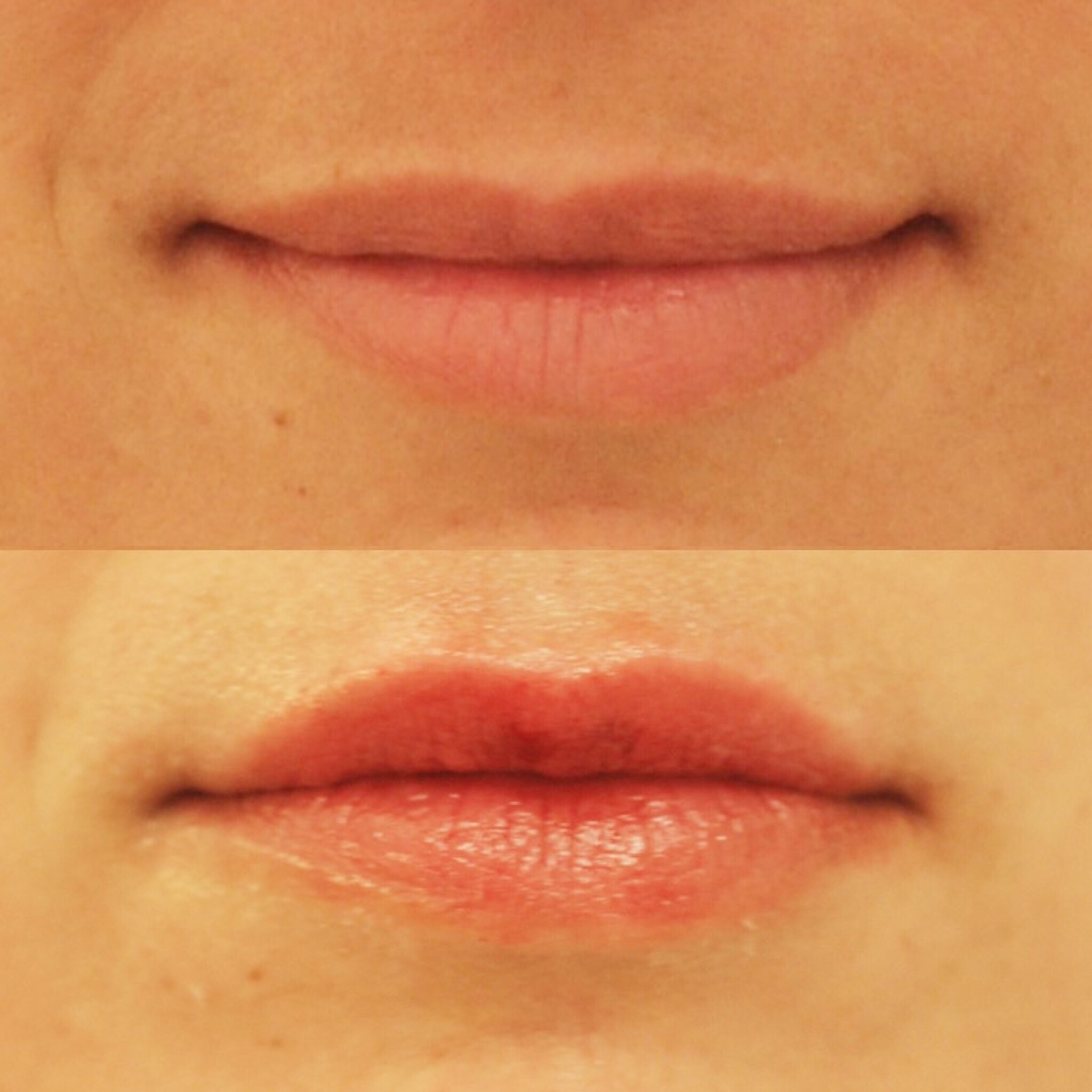 Actual patient of Dr. Devgan, before and after lip augmentation