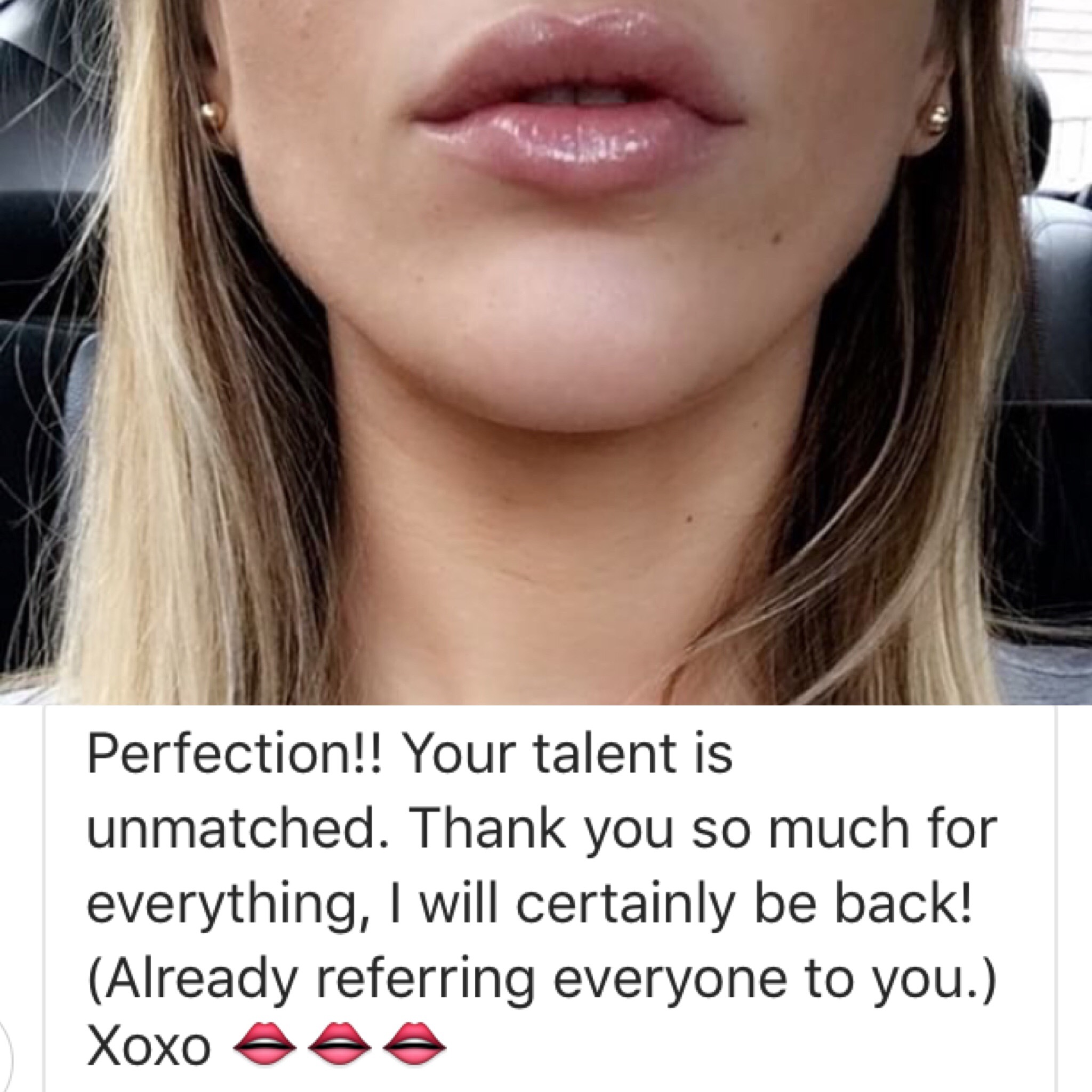 Message and photo from a lip augmentation patient, 7/2016