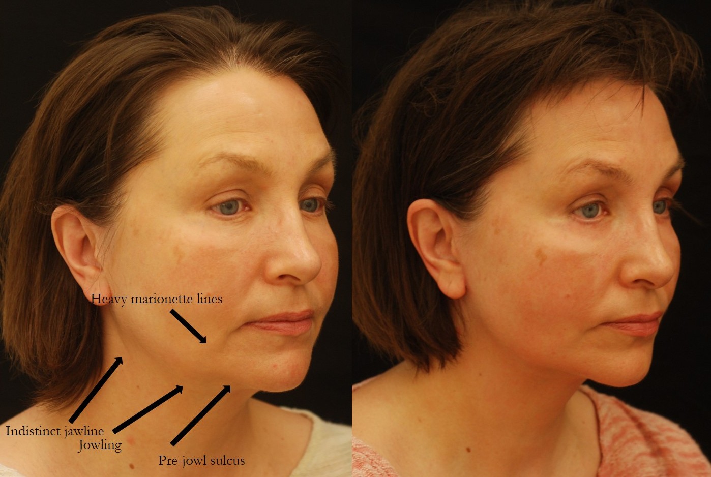 Actual patient of Dr. Devgan, before and after revision facelift, necklift, and lower eyelid blepharoplasty. This result is shown 6 weeks after surgery.