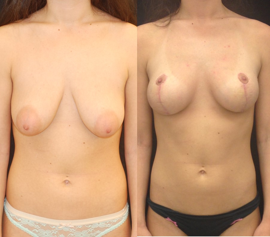 Actual patient of Dr. Devgan, before and after breast lift (mastopexy).