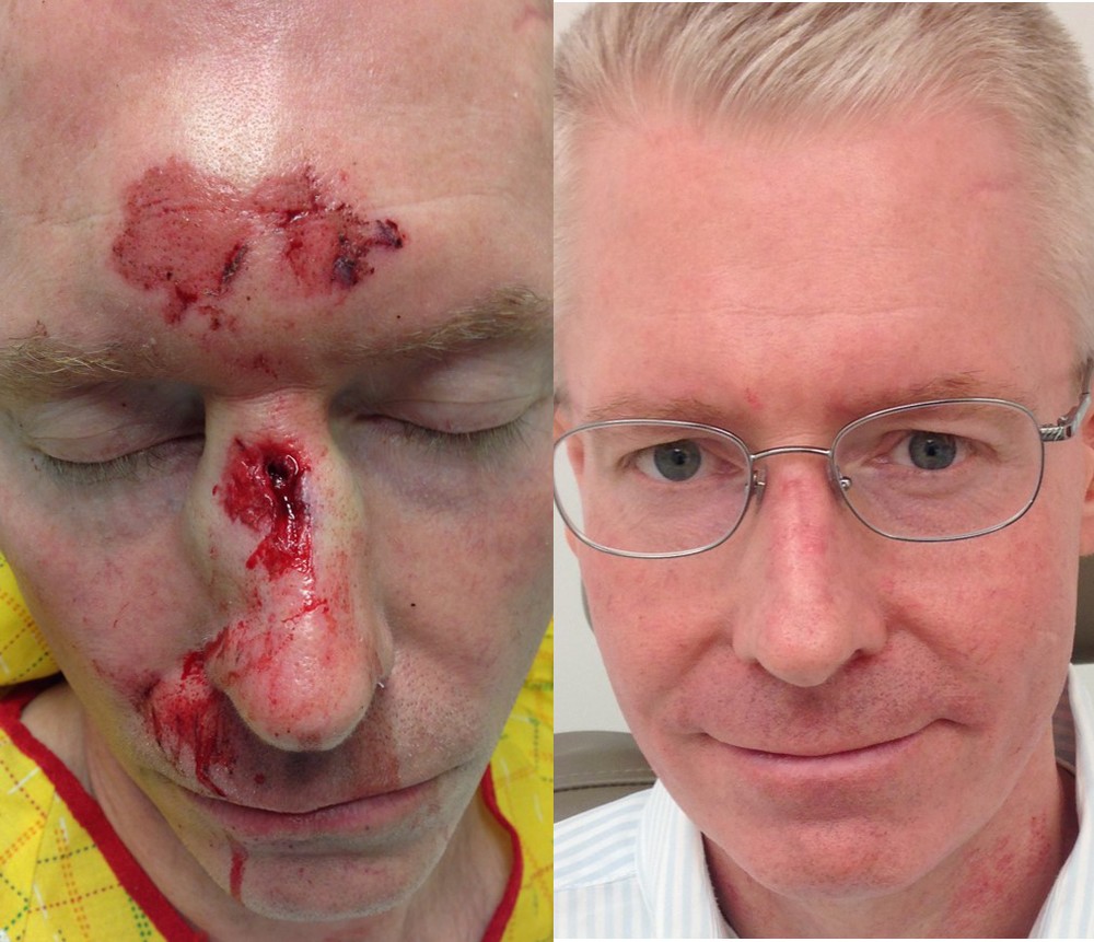 Actual patient of Dr. Devgan, before and after reconstructive nasal surgery