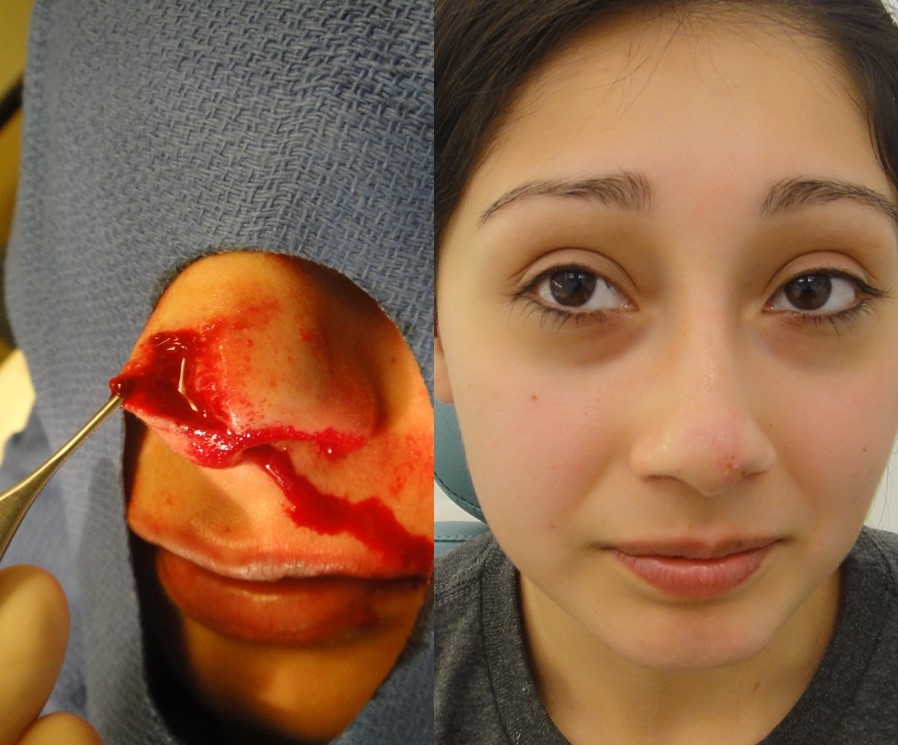 Actual patient of Dr. Devgan, before and after reconstructive nasal surgery