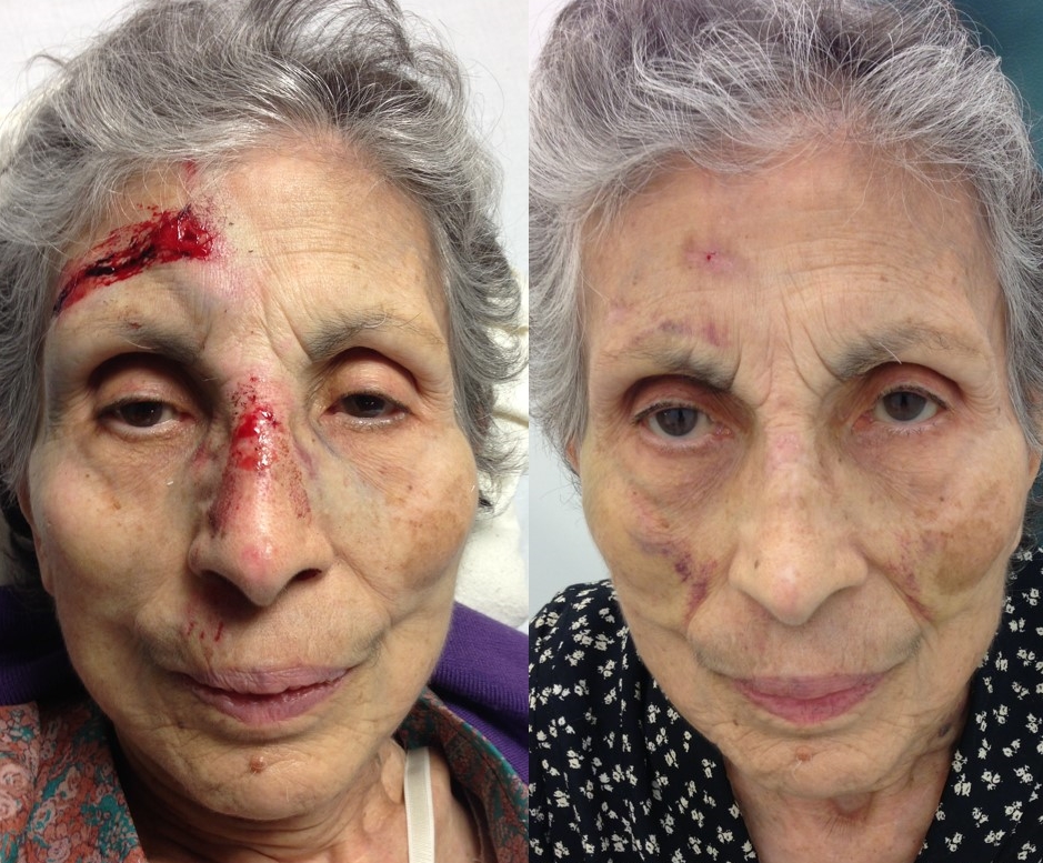 Actual patient of Dr. Devgan, before and after reconstructive nasal surgery