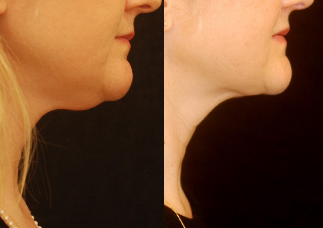Actual patient of Dr. Devgan, before and after under-the-chin liposuction