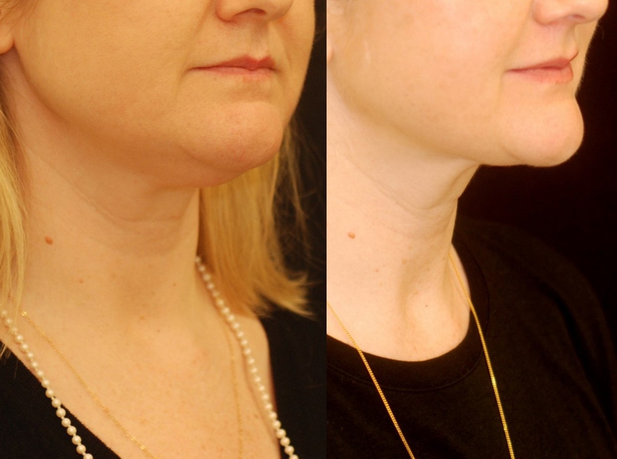 Actual patient of Dr. Devgan, before and after under-the-chin liposuction