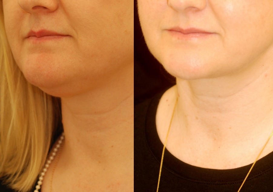 Actual patient of Dr. Devgan, before and after under-the-chin liposuction