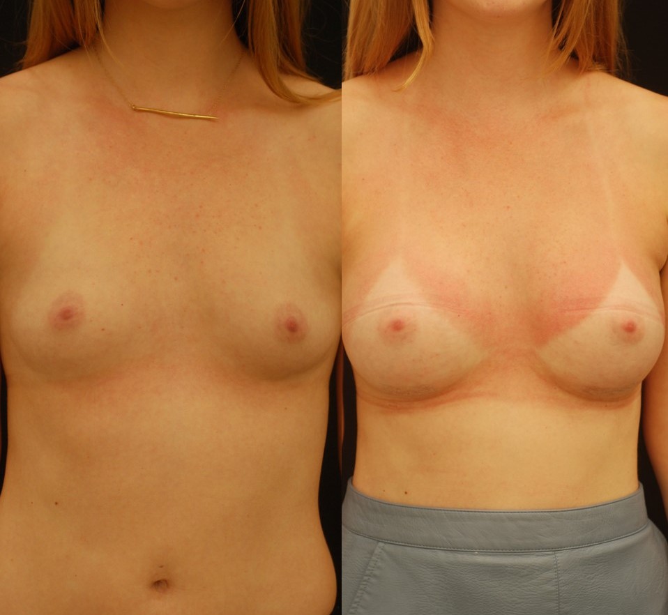 Actual patient of Dr. Devgan, before and after breast augmentation, with a rapid recovery technique and minimal downtime