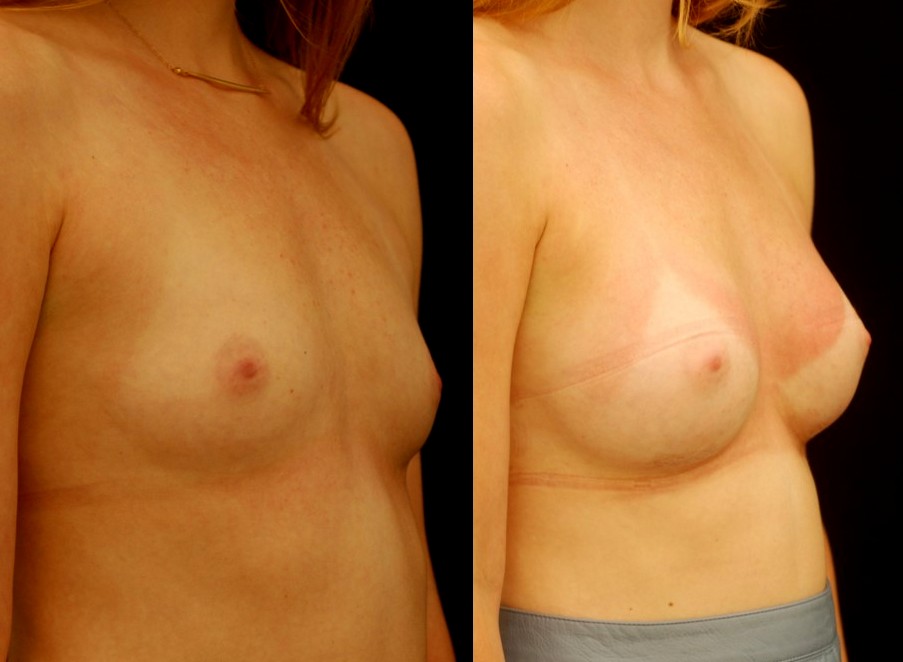 Actual patient of Dr. Devgan, before and after breast augmentation, with a rapid recovery technique and minimal downtime
