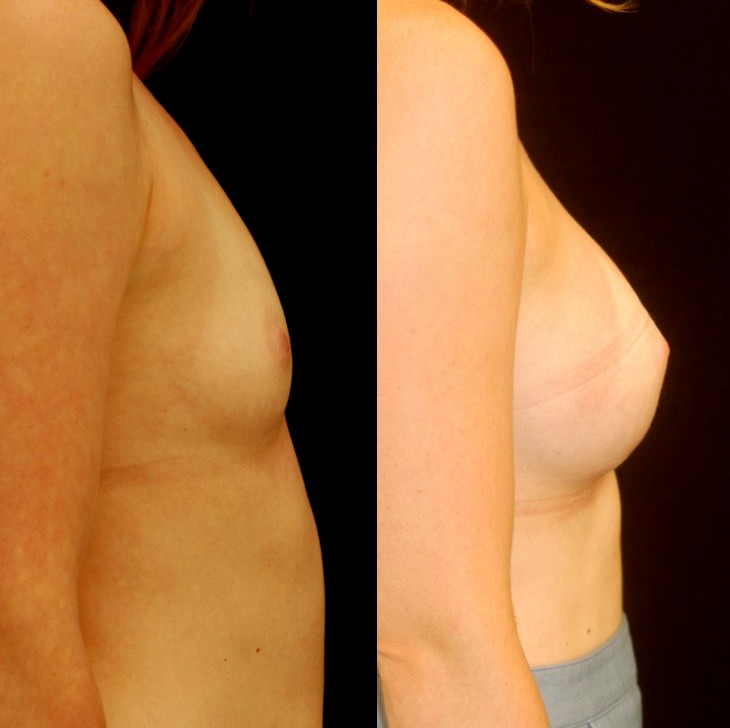 Actual patient of Dr. Devgan, before and after breast augmentation, with a rapid recovery technique and minimal downtime