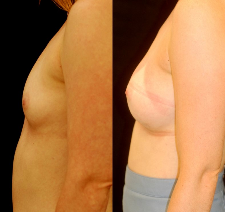 Actual patient of Dr. Devgan, before and after breast augmentation, with a rapid recovery technique and minimal downtime