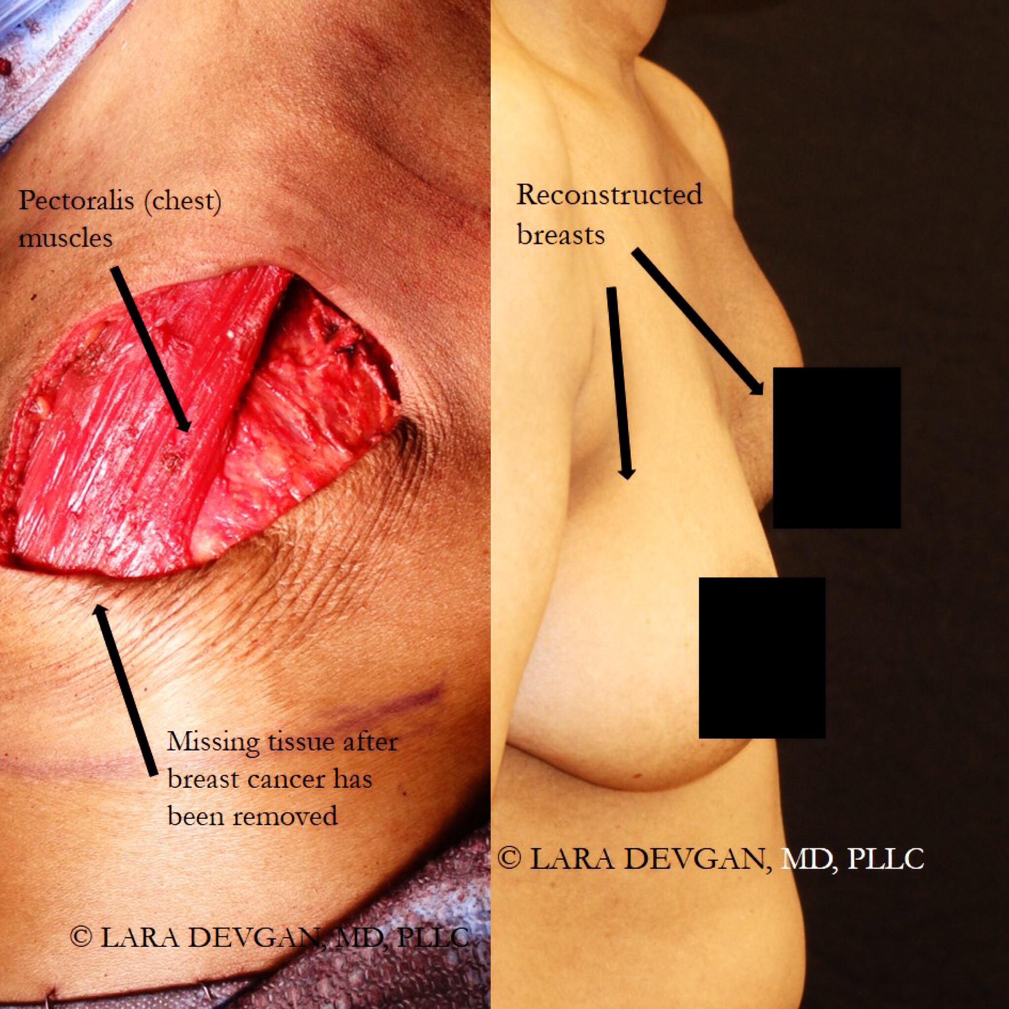 Actual patient of Dr. Devgan, before and after breast cancer reconstruction.