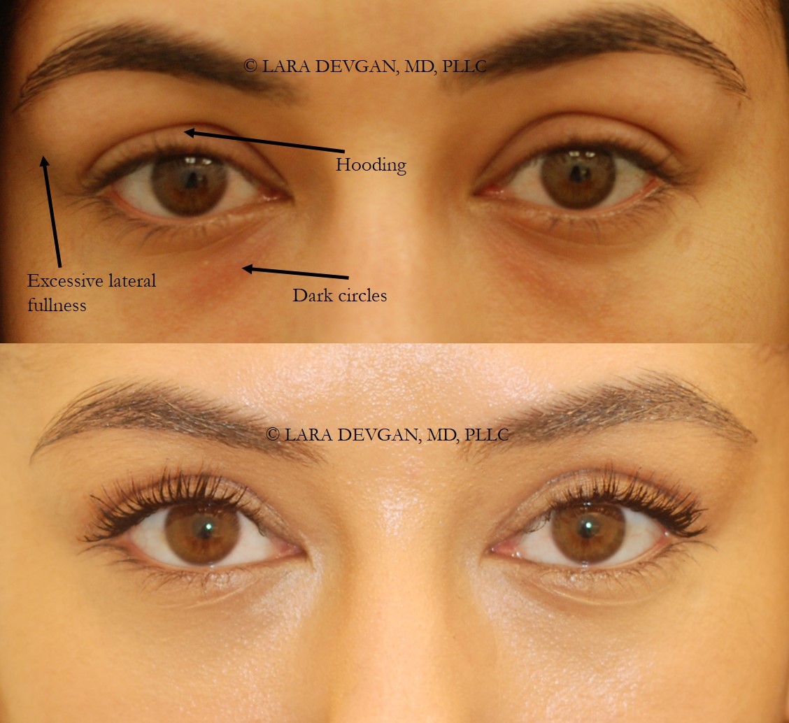 Actual patient of Dr. Devgan, before and 2 weeks after upper and lower eyelid blepharoplasty.