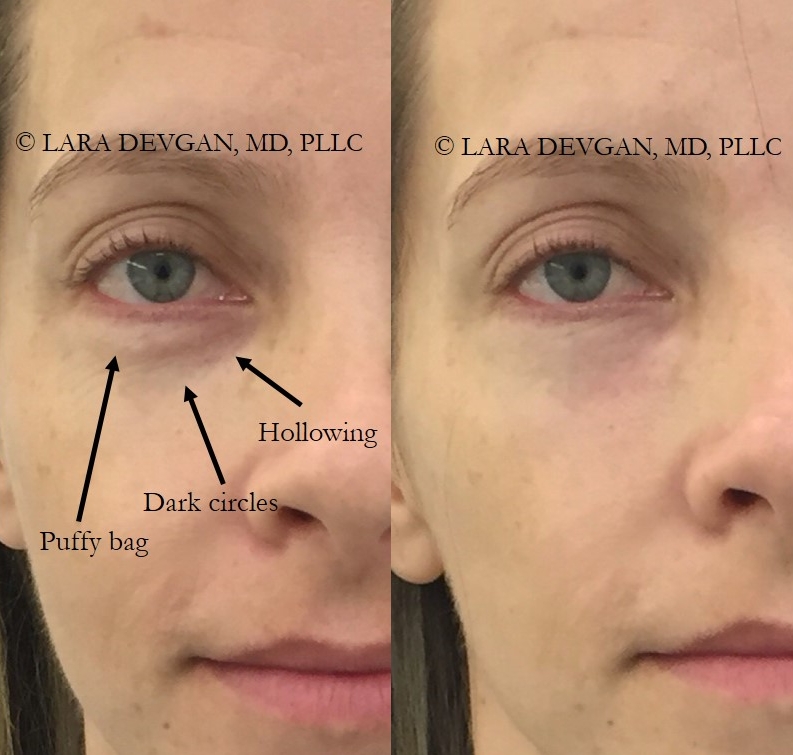 before and after under eye filler