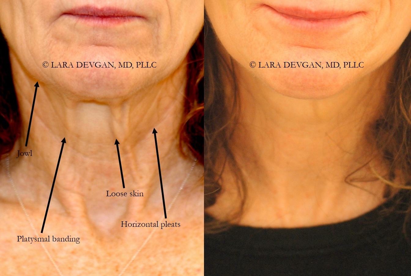 Actual patient of Dr. Devgan, before and after facelift and necklift (short-scar approach) with fat grafting.