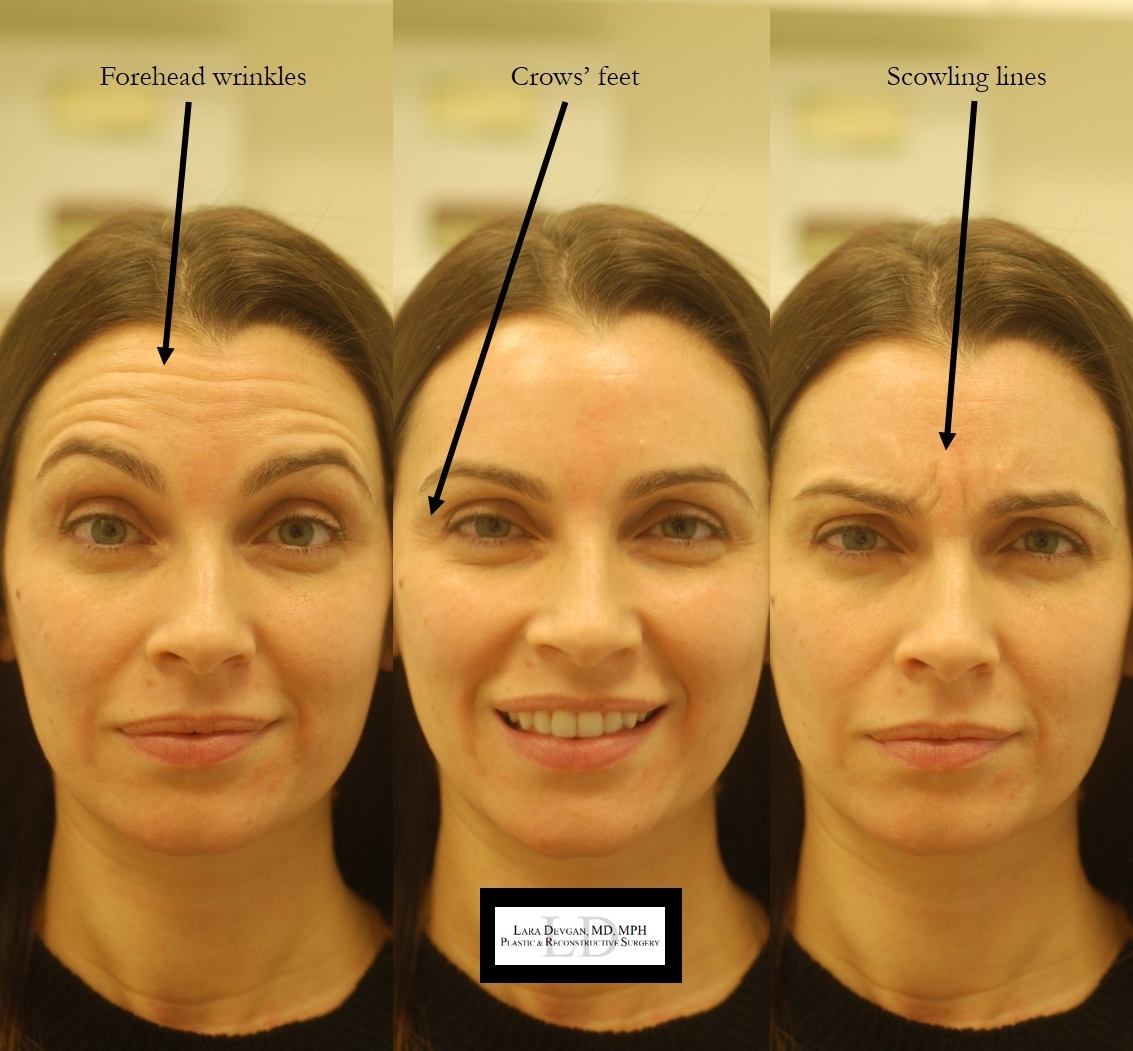 Botox 101: How To Use Botox For Cosmetic Improvements Of The Face — Lara  Devgan, Md, Mph, Facs