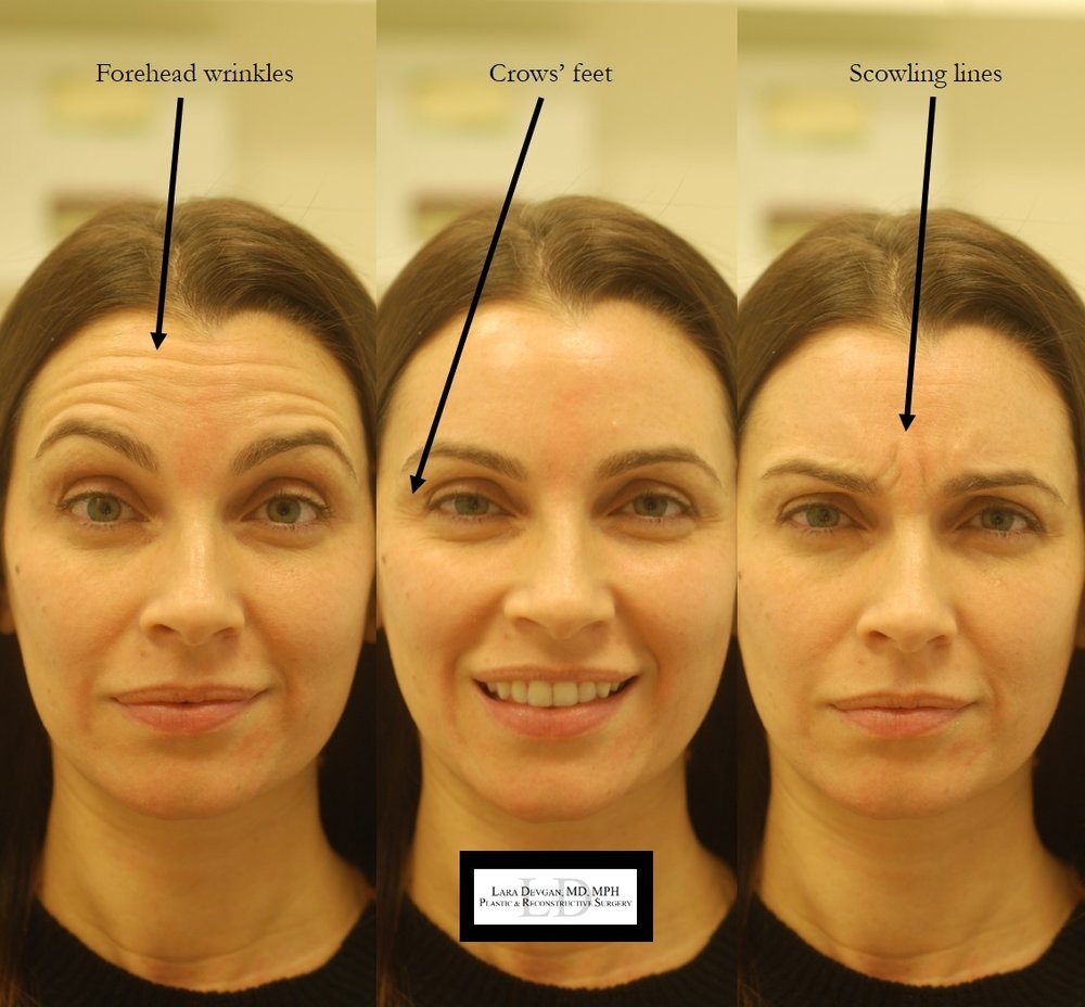 Allergan Botox 