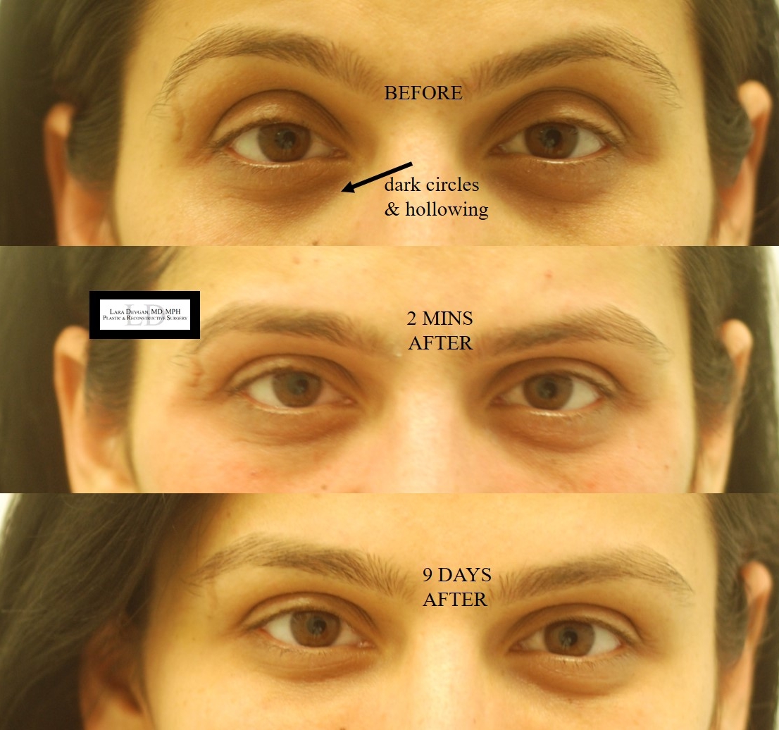 Actual patient of Dr. Devgan, before and after tear trough augmentation