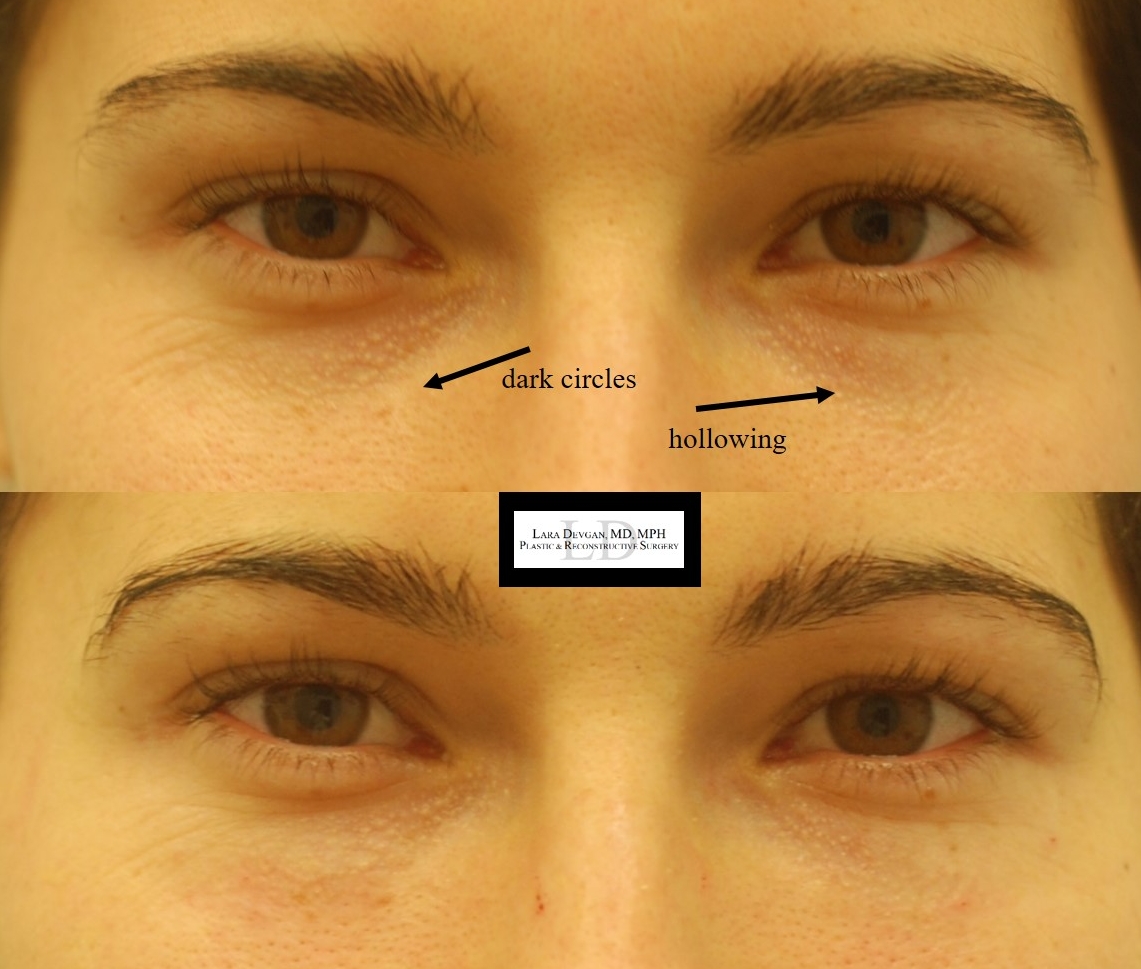 Actual patient of Dr. Devgan, before and after tear trough augmentation