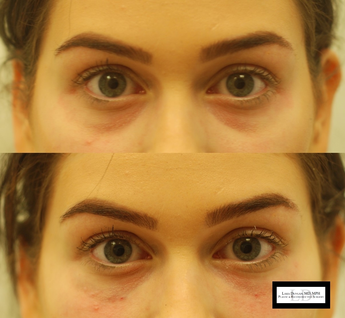 Actual patient of Dr. Devgan, before and after tear trough augmentation