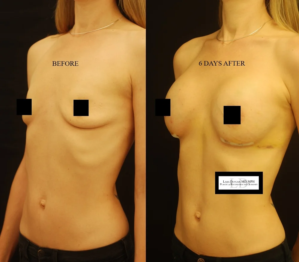 best breast augmentation surgeons nyc