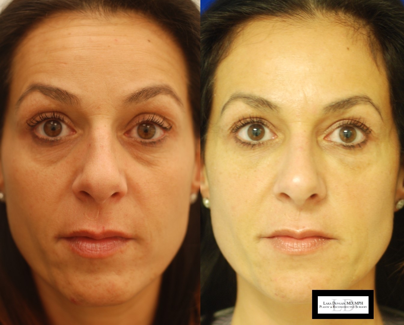 Actual patient of Dr. Devgan, before and after tear trough augmentation. New York City, New York
