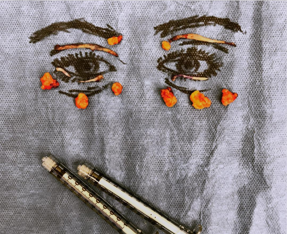 Art of Blepharoplasty