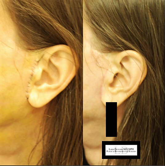 Facelift/necklift scare 5 days after (right), and 5 weeks after (left).